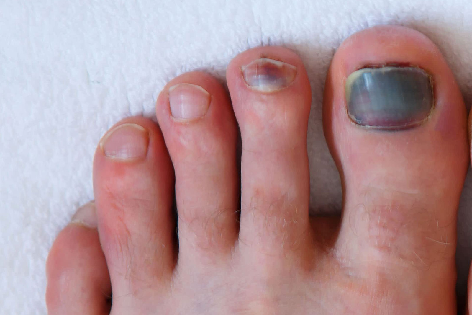 THE PODIATRY - Subungual haematomas (Bleeding under nail)