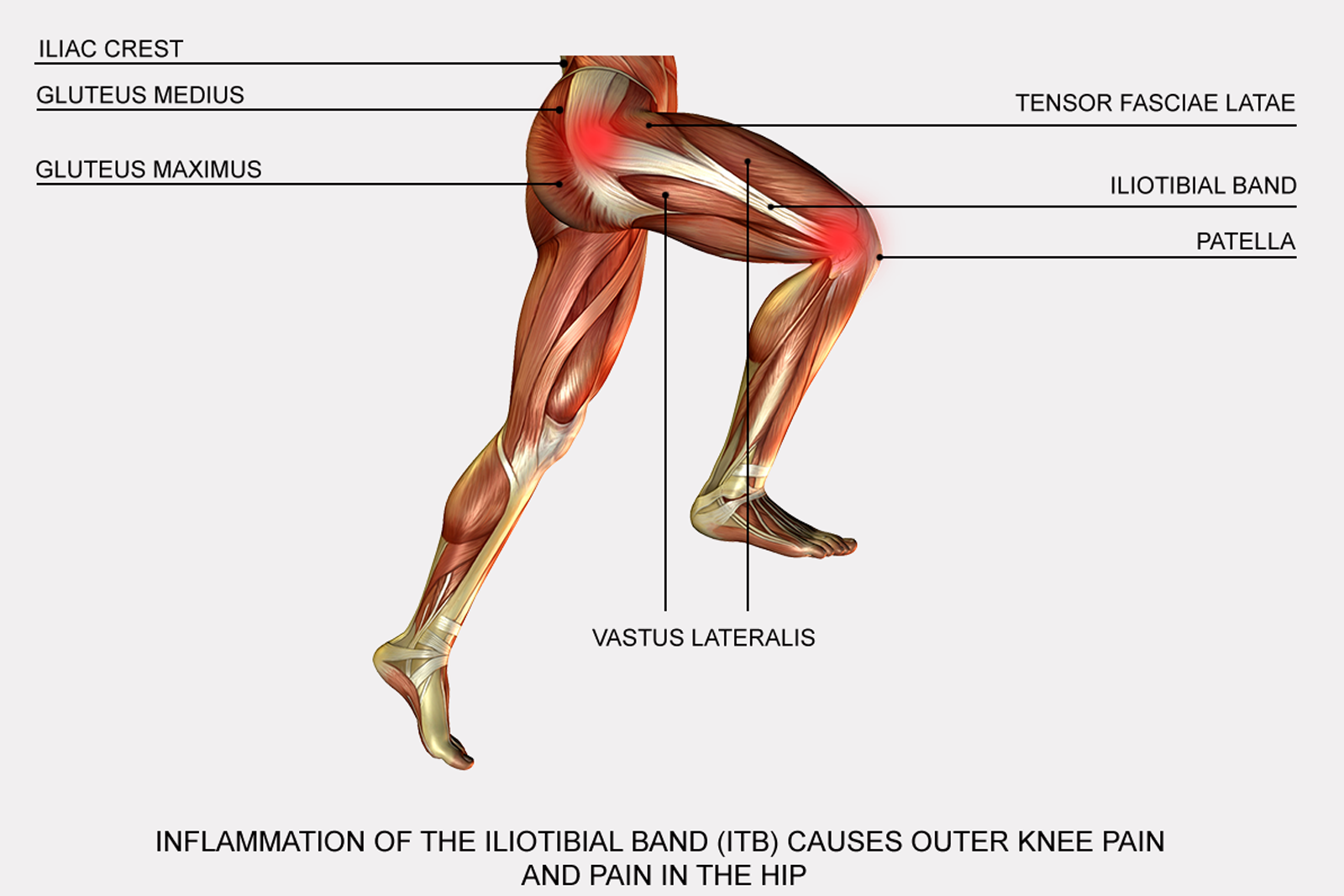 Illiotbial band syndrome